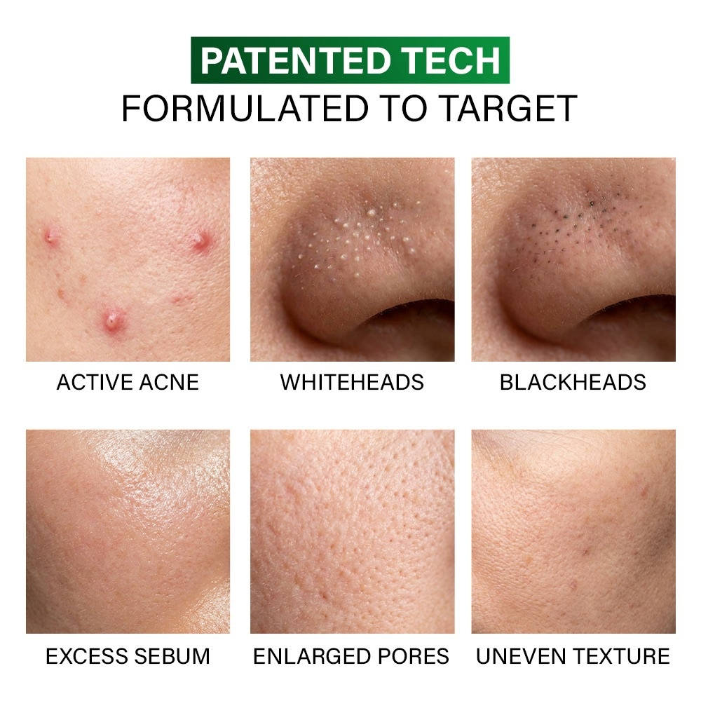 Acne Clearing Foaming Cleanser, Facewash For Pimples, Sensitive Skin, Dermat Tested | FC3 - view 3