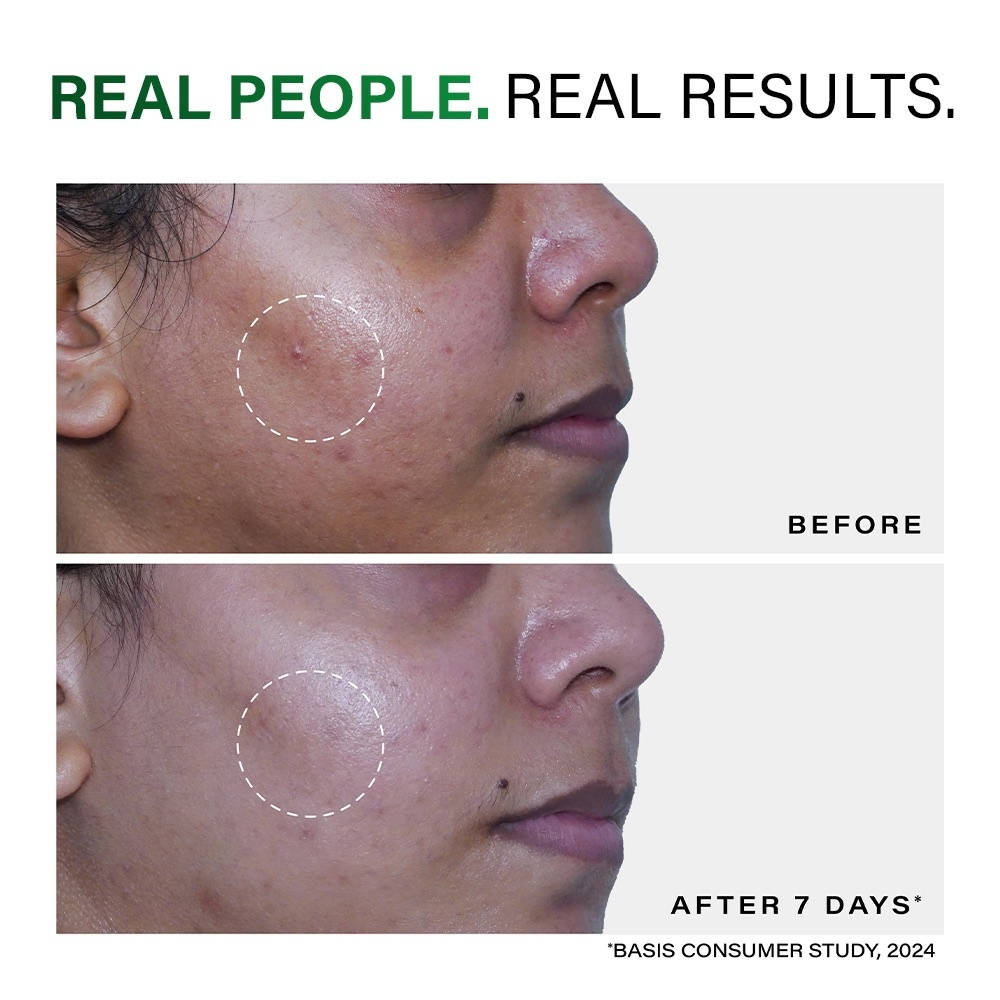 Acne Clearing Foaming Cleanser, Facewash For Pimples, Sensitive Skin, Dermat Tested | FC3 - view 4