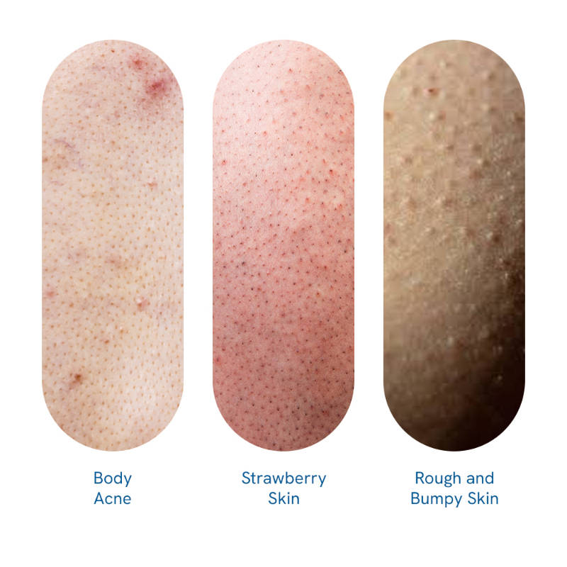 1% Salicylic Acid Body Wash, Treats Body Acne & Strawberry Skin - Exfoliating Shower Gel | BWS9 - view 21