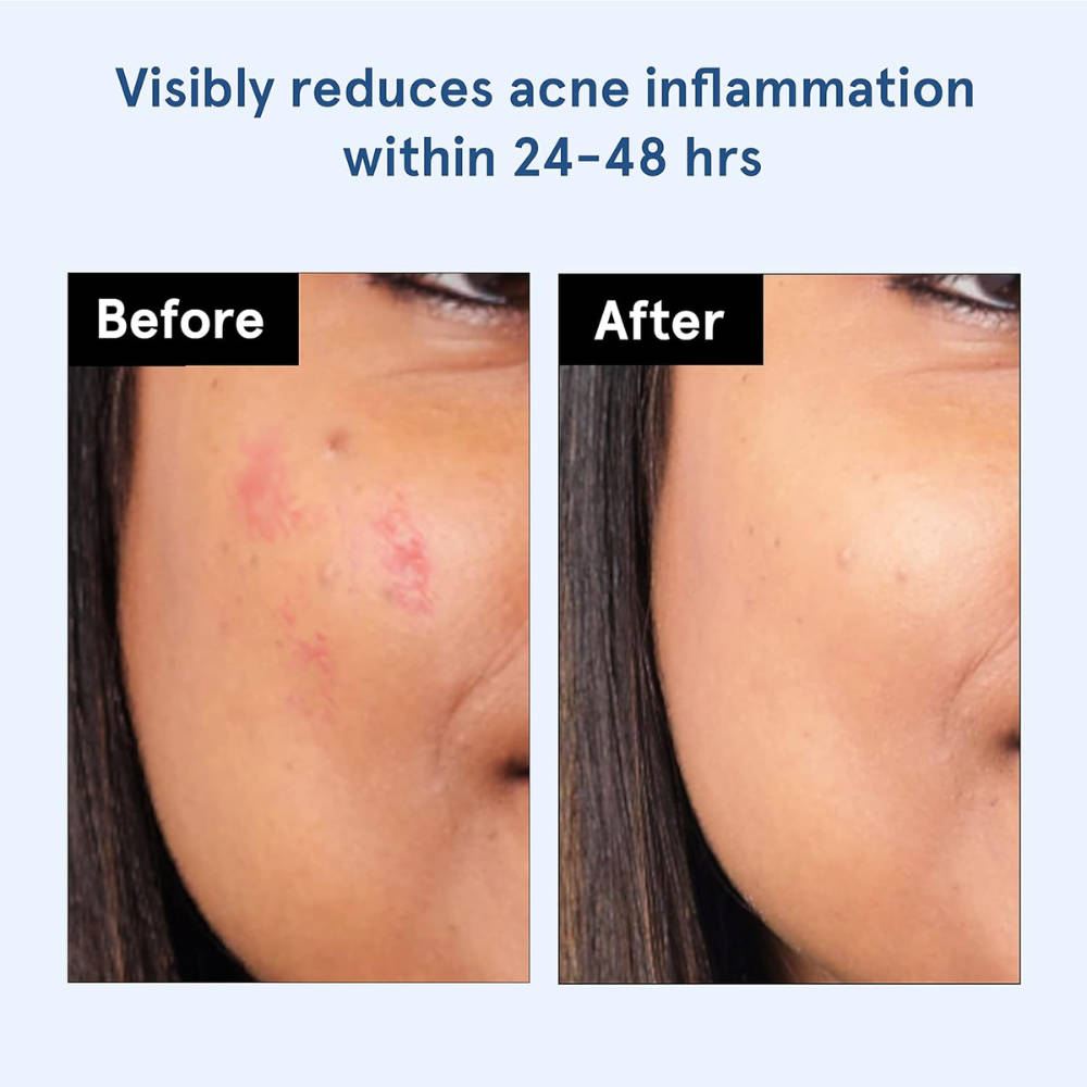 Hydrocolloid Acne Pimple Patch Absorbs & Flattens Acne Overnight | BWS9 - view 3