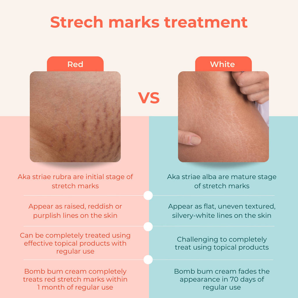 Bomb Bum Cream for Stretch Marks & Cellulite Body Firming Cream with Caffeine & Peptides | B20 - view 7