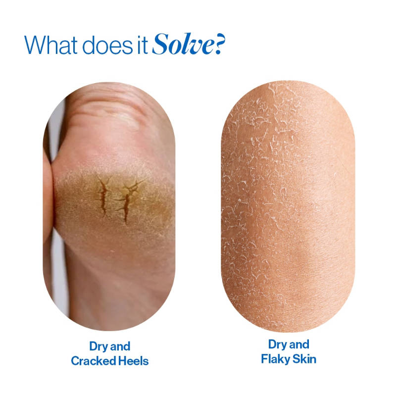 Urea Skin & Heel Repair Kit Combo | BWS9 - view 3