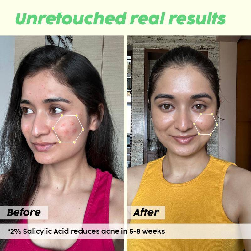 2% Salicylic Acid Acne Spot Corrector Gel For Reducing Active Acne, Controls Oil and Acne Scars | PL1 - view 4