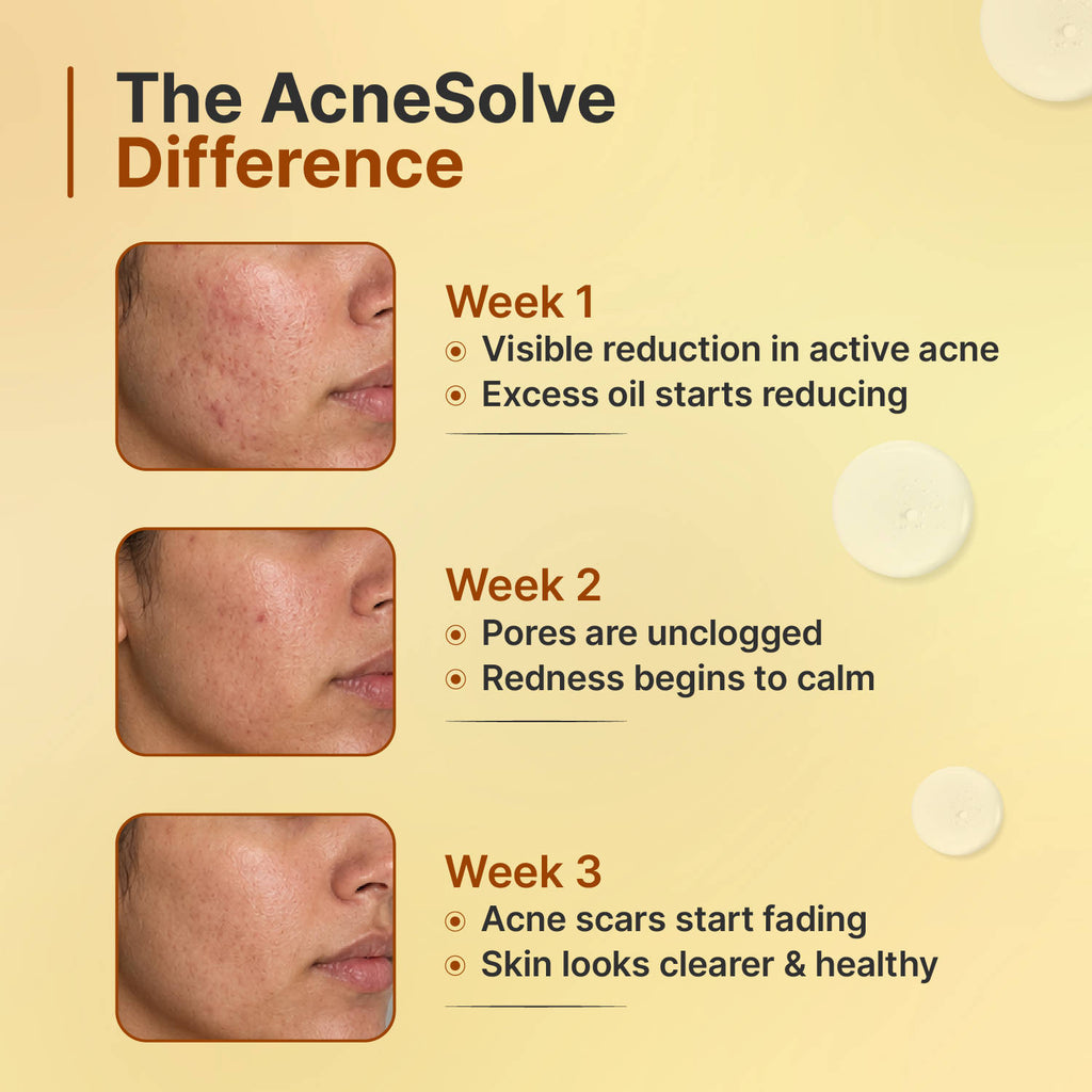 Acnesolve Serum | Z8 - view 8