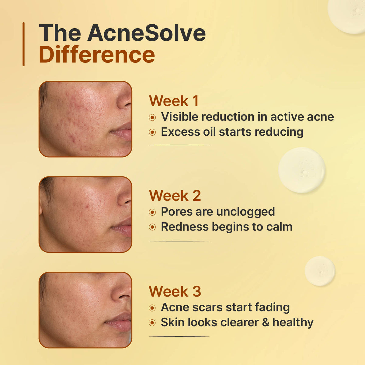 Acnesolve Serum | Z8 - view 8