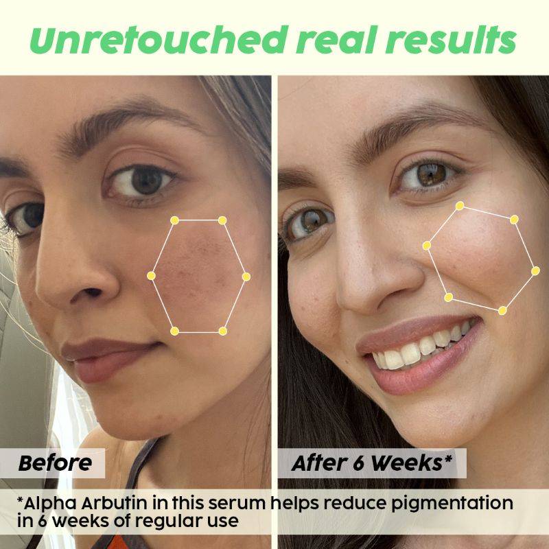 2% Alpha Arbutin Pineapple Serum for Pigmentation & Dark Spot Reduction | PL1 - view 4