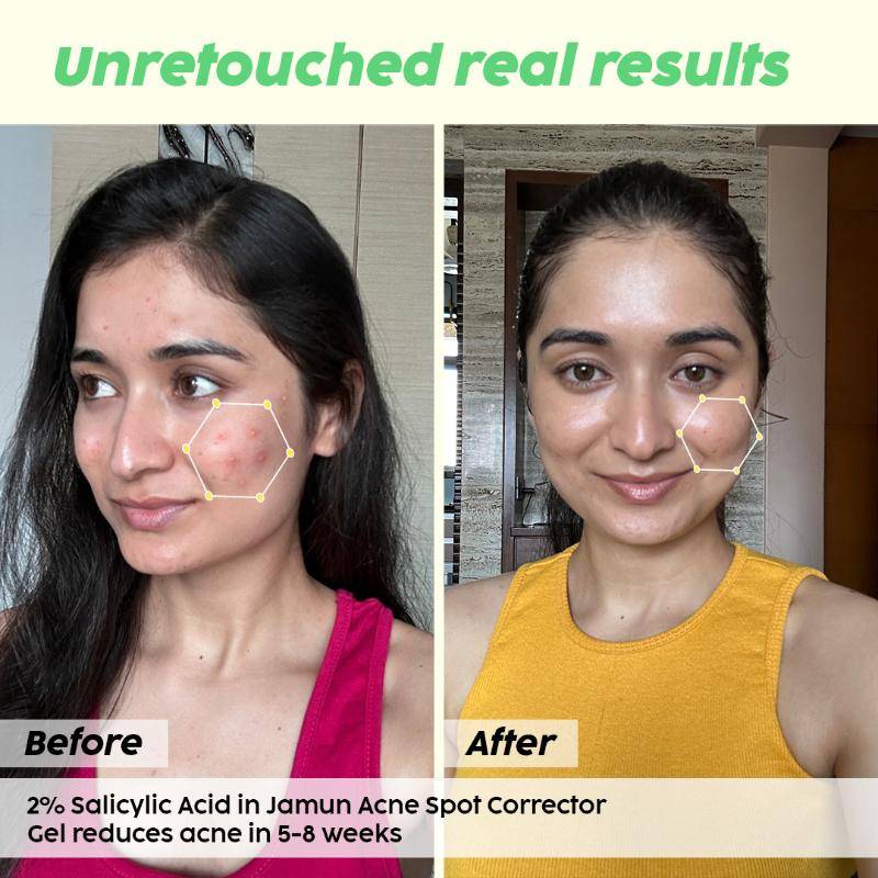 Salicylic Acid Face Cleanser & Spot Corrector Gel Combo | PL1 - view 4