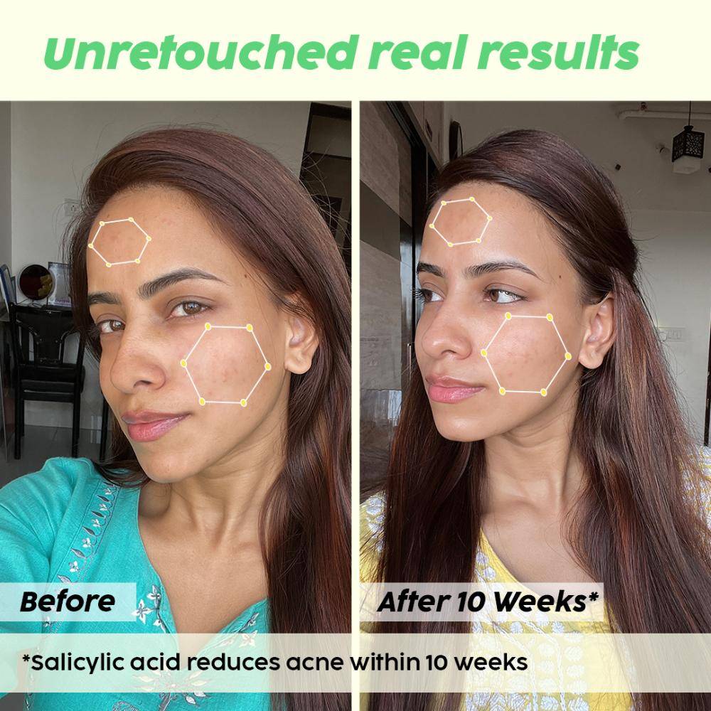 0.5% Salicylic Acid Jamun Face Wash Cleanser For Active Acne & Oil Control, Acne Breakouts | PL1 - view 11