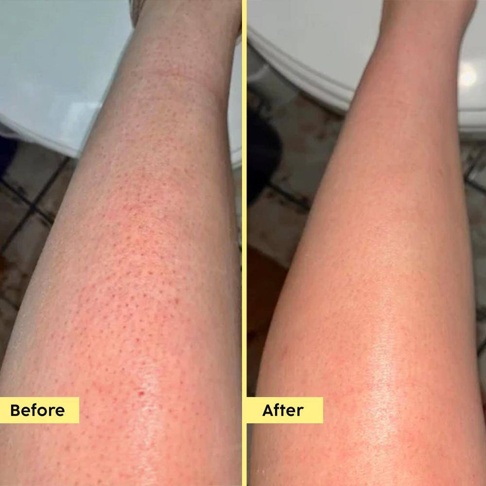 Pineapple 5% Lactic Acid Body Wash Exfoliates Dry, Rough & Strawberry Skin With Deep Cleansing | PL1 - view 6