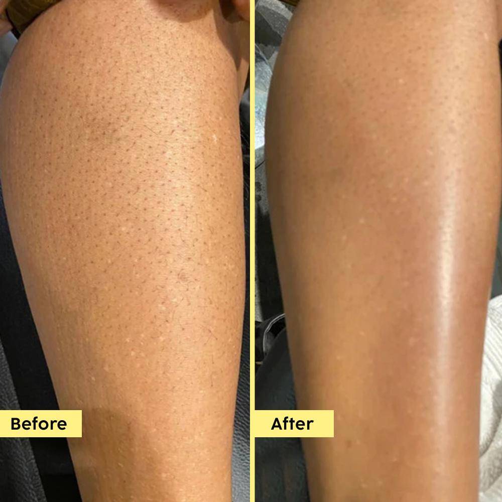 Pineapple 5% Lactic Acid Body Wash Exfoliates Dry, Rough & Strawberry Skin With Deep Cleansing | PL1 - view 7