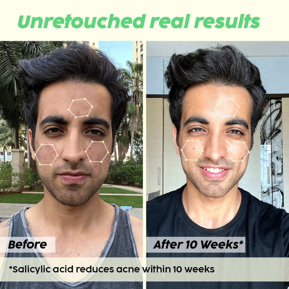 Jamun Active Acne Kit With Spf 50+ Sunscreen & Juicy Cleanser For Women & Men | PL1 - view 10