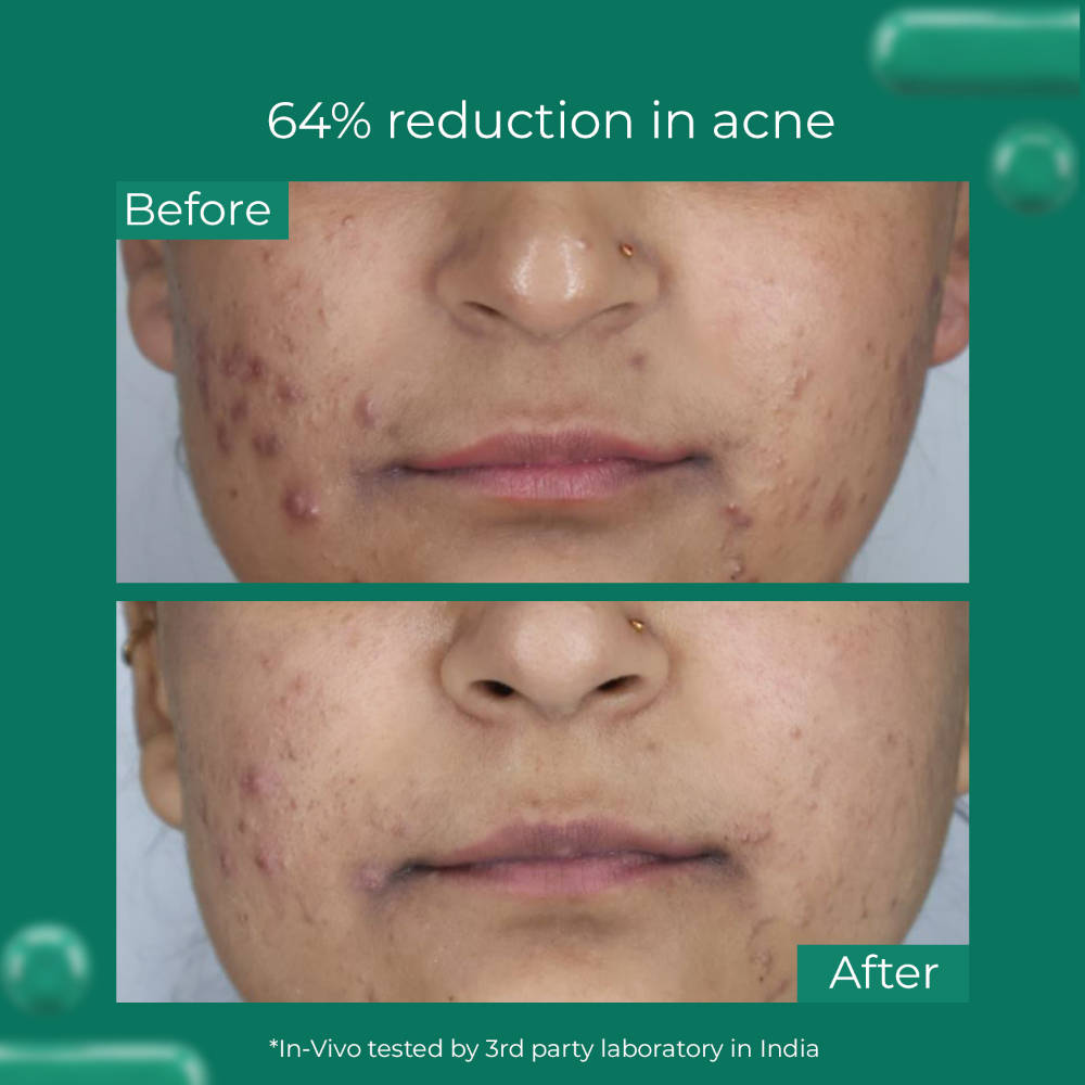 Salicylic Acid Face Serum for Acne & Open Pores, Fades Acne Marks, Reduces Redness | Z8 - view 3
