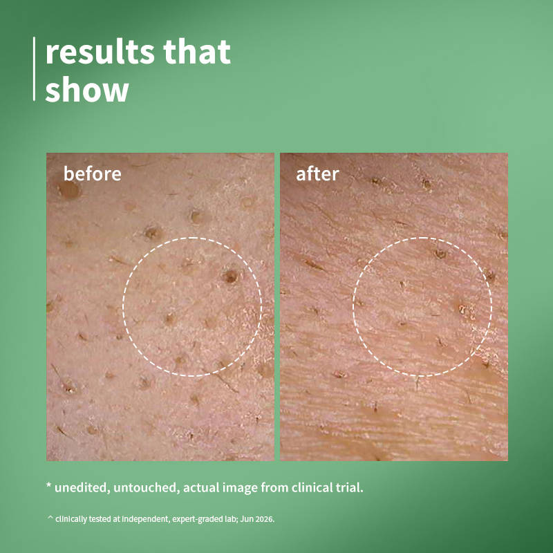2% Encapsulated Salicylic Acid Face Serum | Z8 - view 3