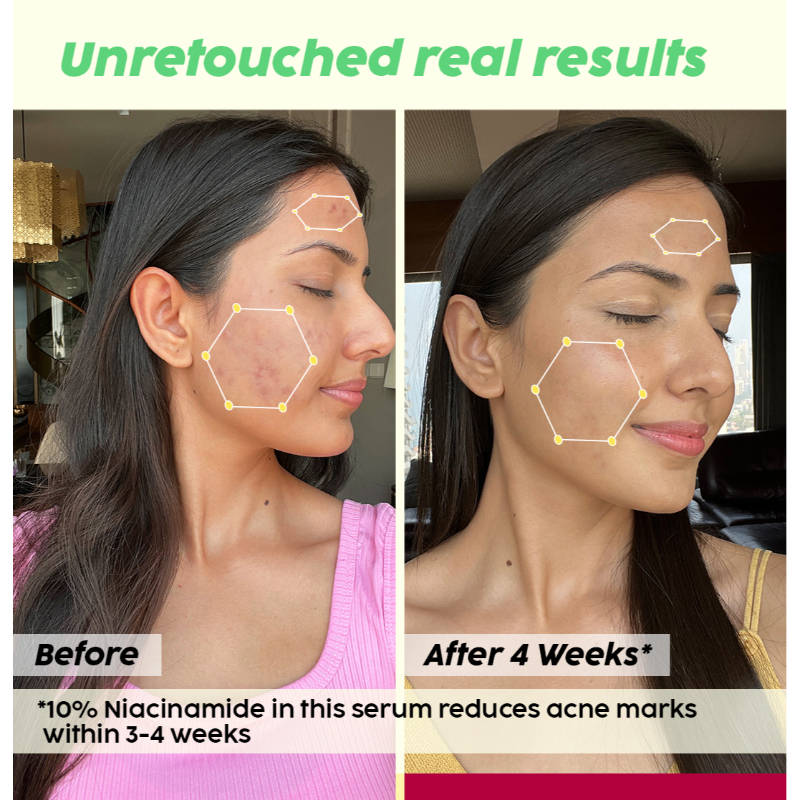 2% Acne Buster Moisturizer & 10% Niacinamide Serum Combo For Oily Skin, Helps Reduce Pimples | PL1 - view 14