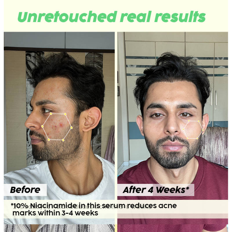 2% Acne Buster Moisturizer & 10% Niacinamide Serum Combo For Oily Skin, Helps Reduce Pimples | PL1 - view 15