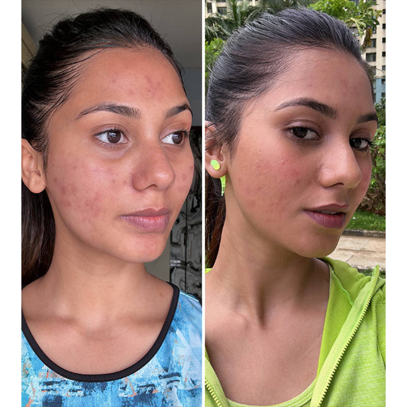 2% Acne Buster Moisturizer & 10% Niacinamide Serum Combo For Oily Skin, Helps Reduce Pimples | PL1 - view 8