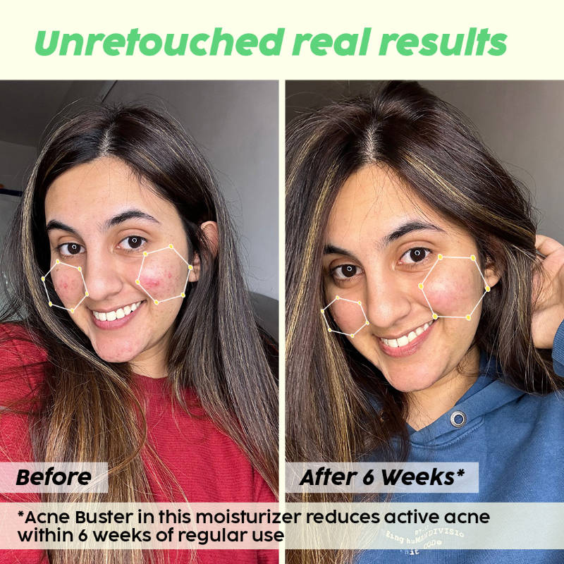 2% Salicylic Acid Active Acne Control Serum & Acne Buster Moisturizer Combo, Reduce Pimples | PL1 - view 13