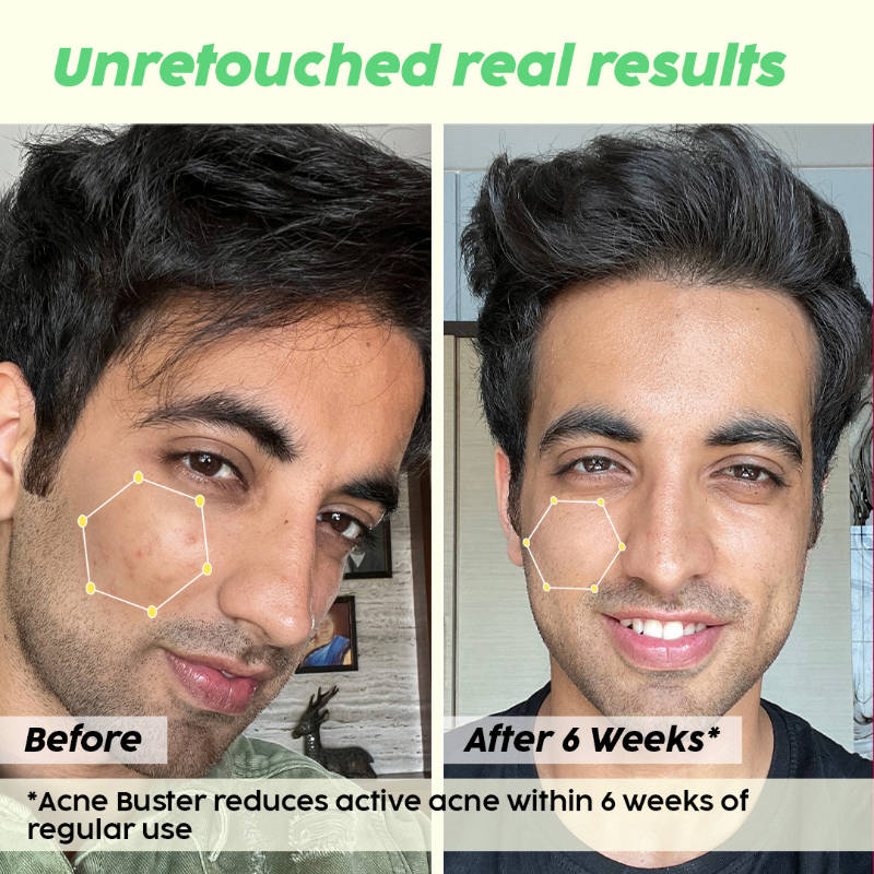 2% Salicylic Acid Active Acne Control Serum & Acne Buster Moisturizer Combo, Reduce Pimples | PL1 - view 14