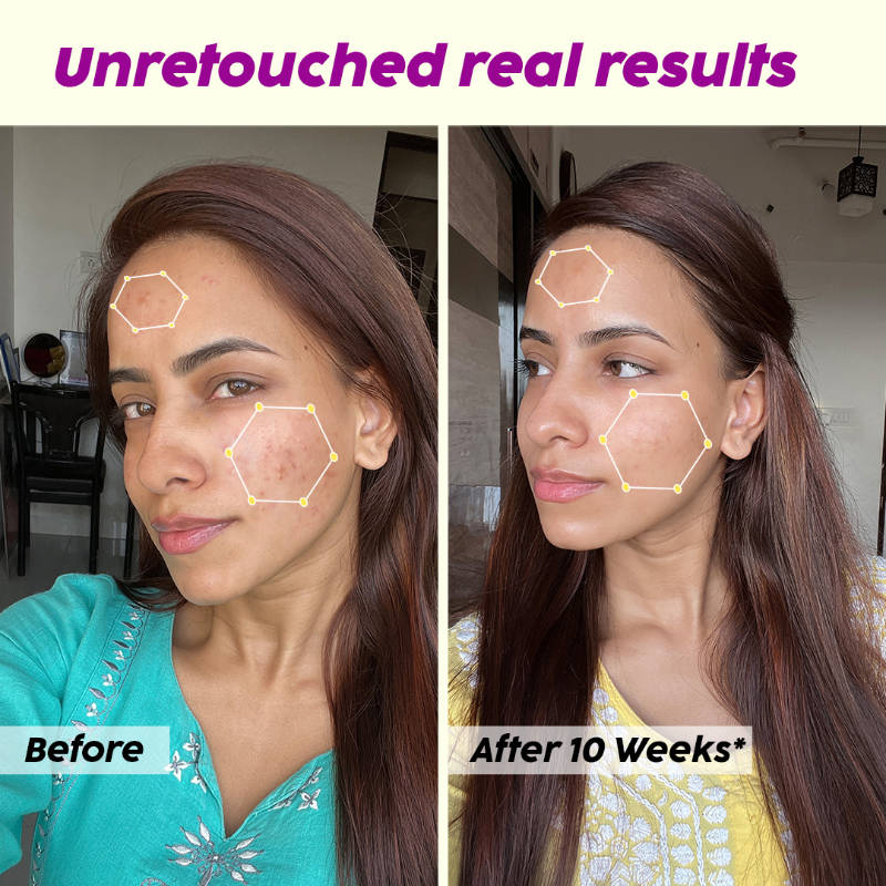 Jamun Face Wash & Acne Marks Serum Combo | PL1 - view 11