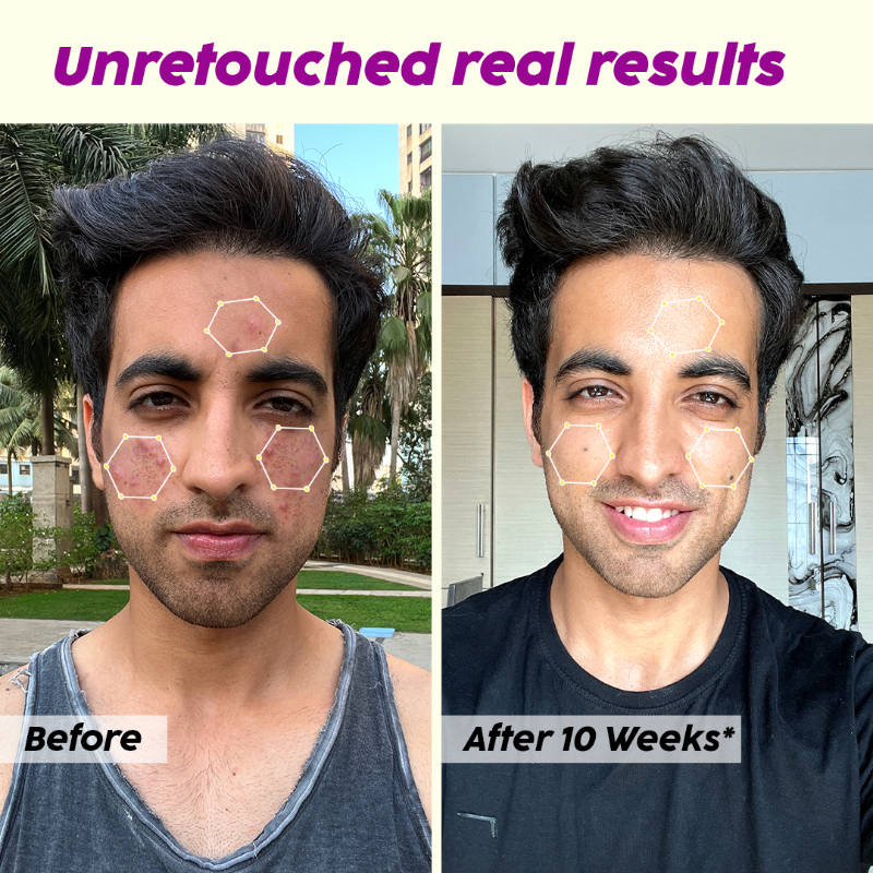 Jamun Face Wash & Acne Marks Serum Combo | PL1 - view 12