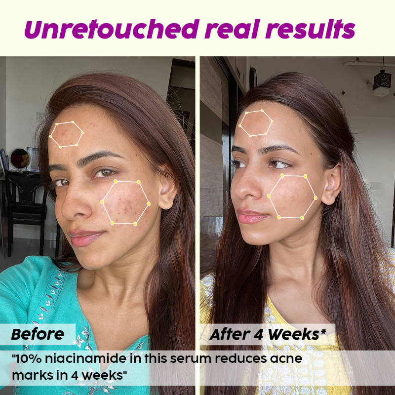10% Niacinamide Acne Care Regime Combo | PL1 - view 13