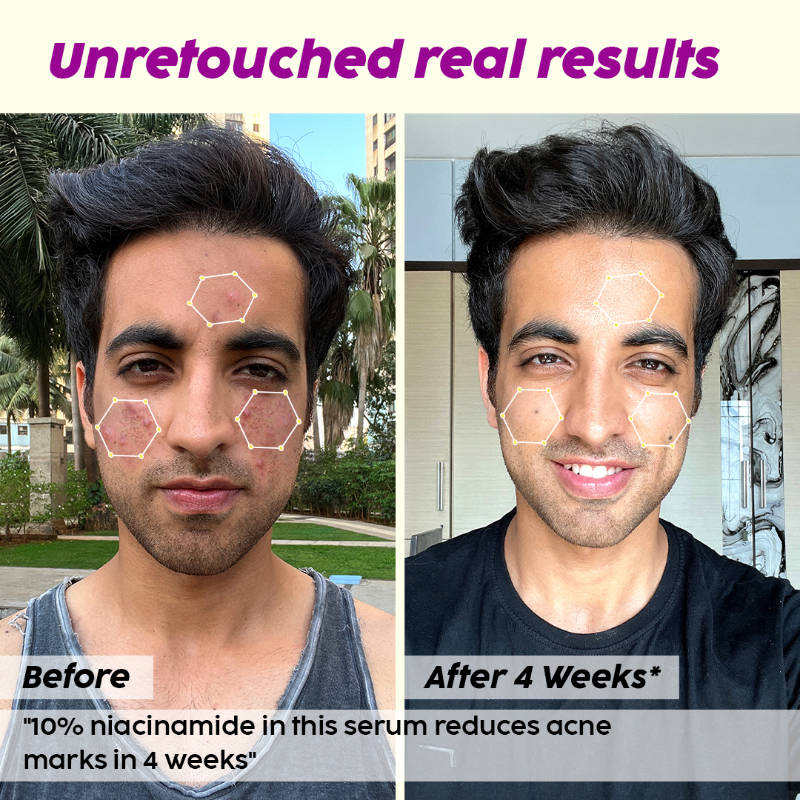 10% Niacinamide Acne Care Regime Combo | PL1 - view 14