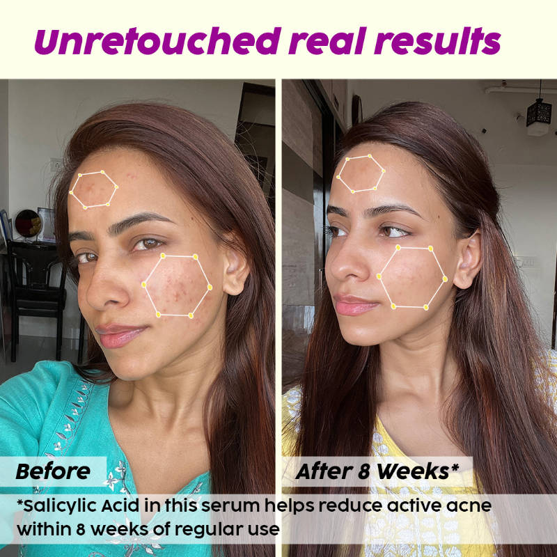 2% Salicylic Acid Active Acne Care Regime | PL1 - view 5