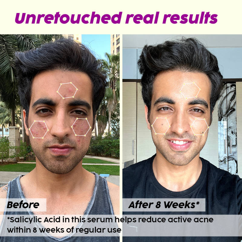 2% Salicylic Acid Active Acne Care Regime | PL1 - view 6