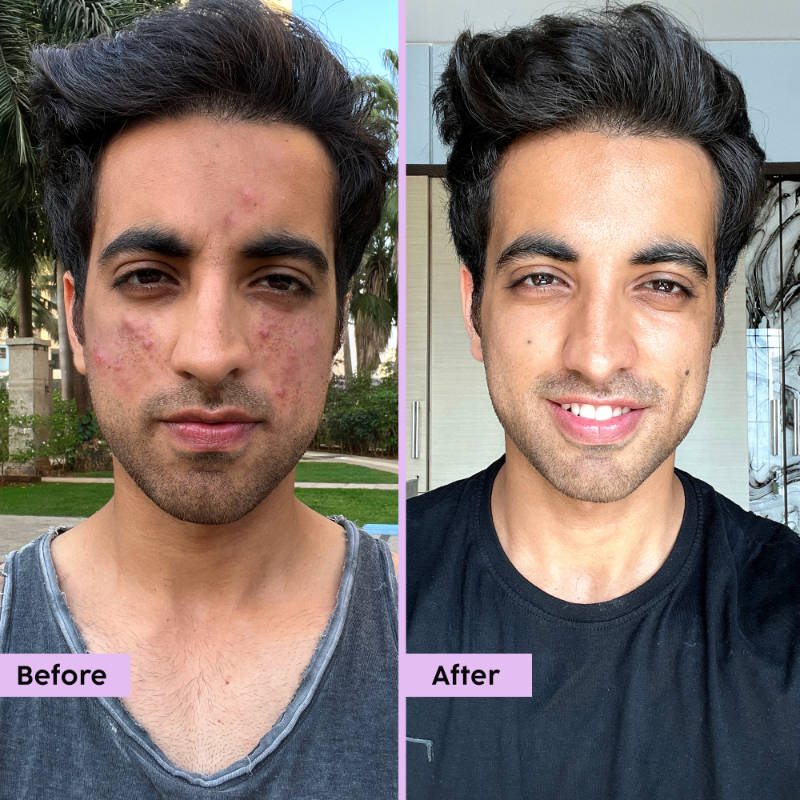 Jamun Face Wash & Active Acne Serum Combo | PL1 - view 13