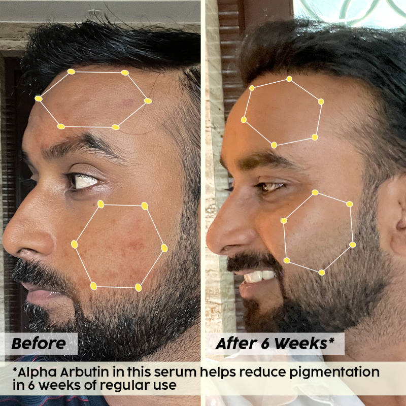 2% Alpha Arbutin Pineapple Serum for Pigmentation & Dark Spot Reduction | Z8 - view 19