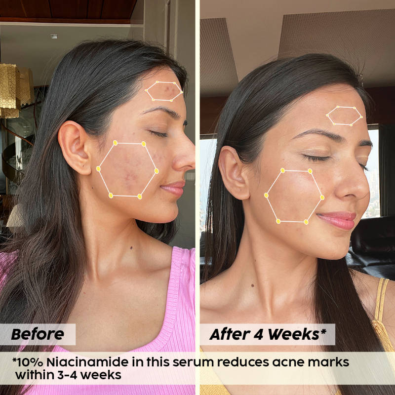 10% Niacinamide Jamun Face Serum for Acne marks, blemishes & oil control | PL1 - view 6