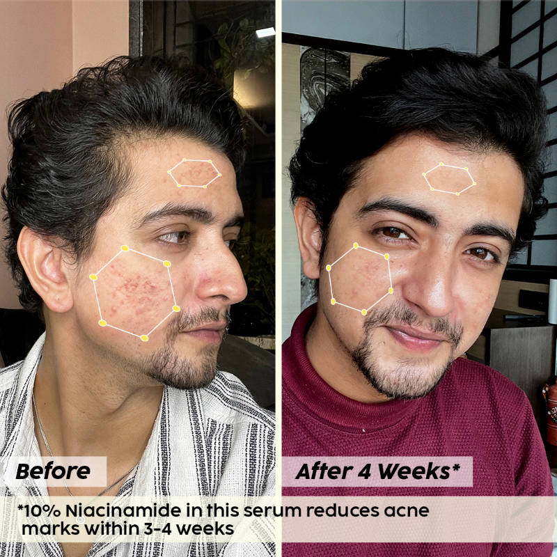 10% Niacinamide Jamun Face Serum for Acne marks, blemishes & oil control | PL1 - view 7