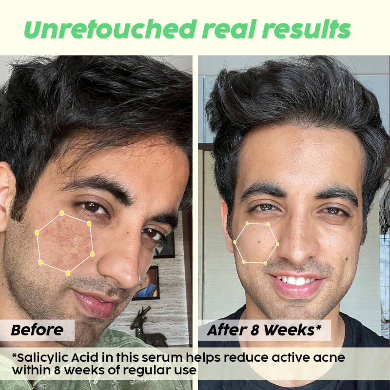 2% Salicylic Acid Jamun Active Acne Control Dewy Serum for Active Acne & Dark Spot Reduction | PL1 - view 10