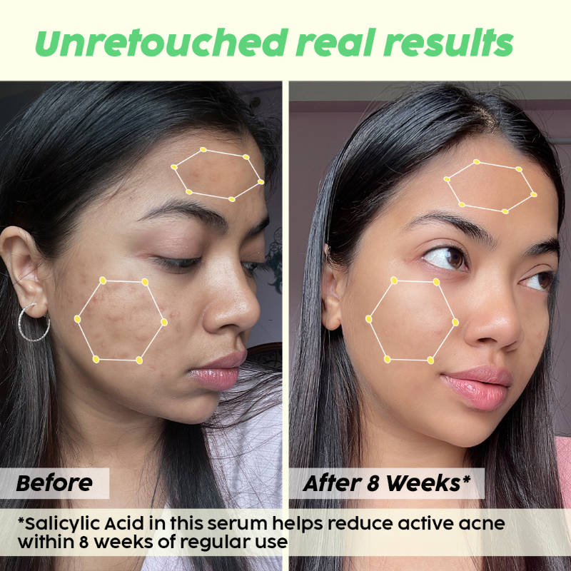 2% Salicylic Acid Jamun Active Acne Control Dewy Serum for Active Acne & Dark Spot Reduction | PL1 - view 8