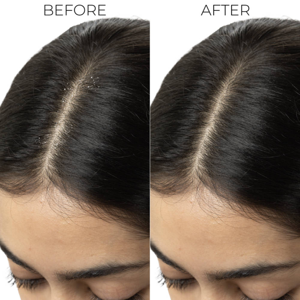 Professional Dandruff Control Shampoo, Reduces Dandruff from 1st Wash | H02 - view 6