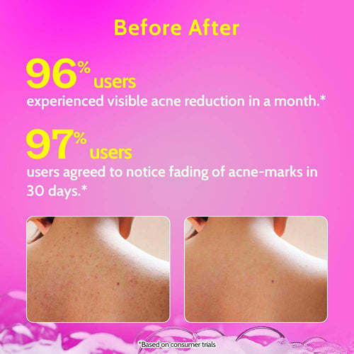 1% Salicylic Acid Acne Control Body Wash For Back And Body Acne And Back Acne | B20 - view 2