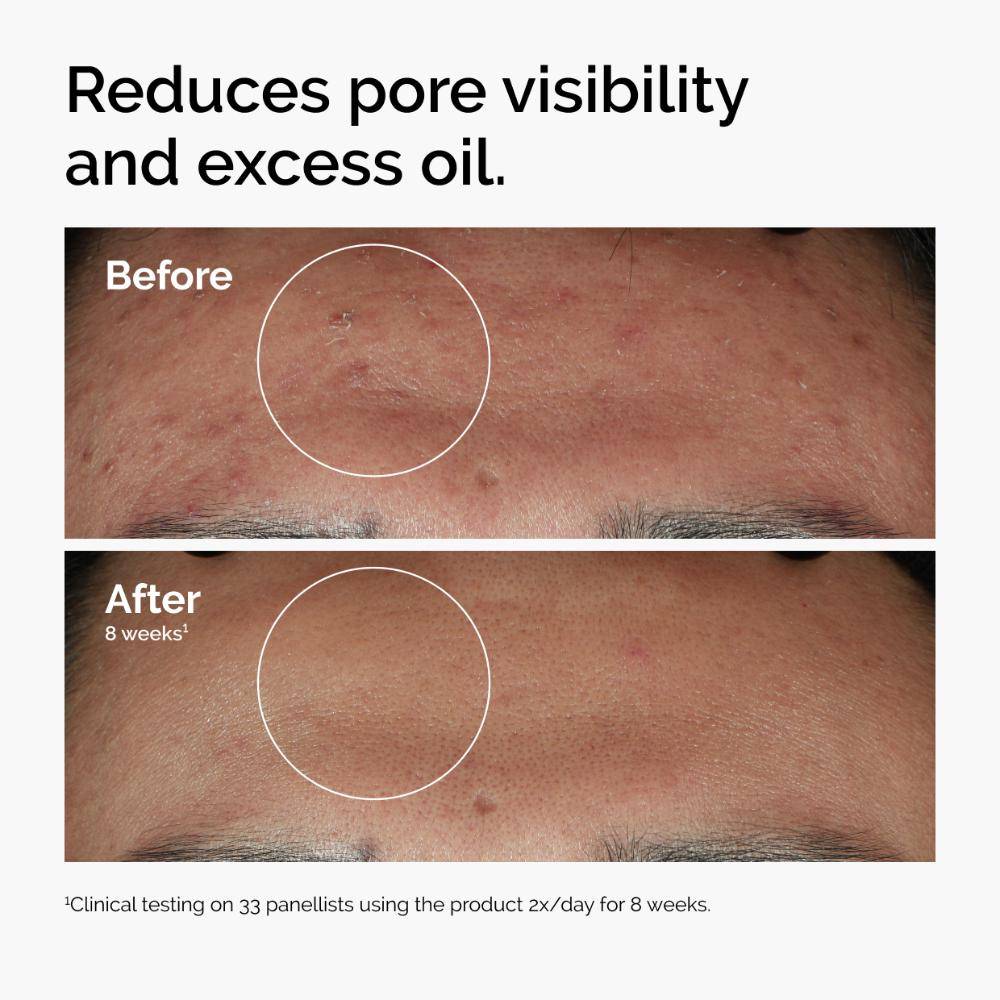 Niacinamide 10% + Zinc 1% High Strength Face Serum for Oil Control and Blemishes | Z8 - view 5