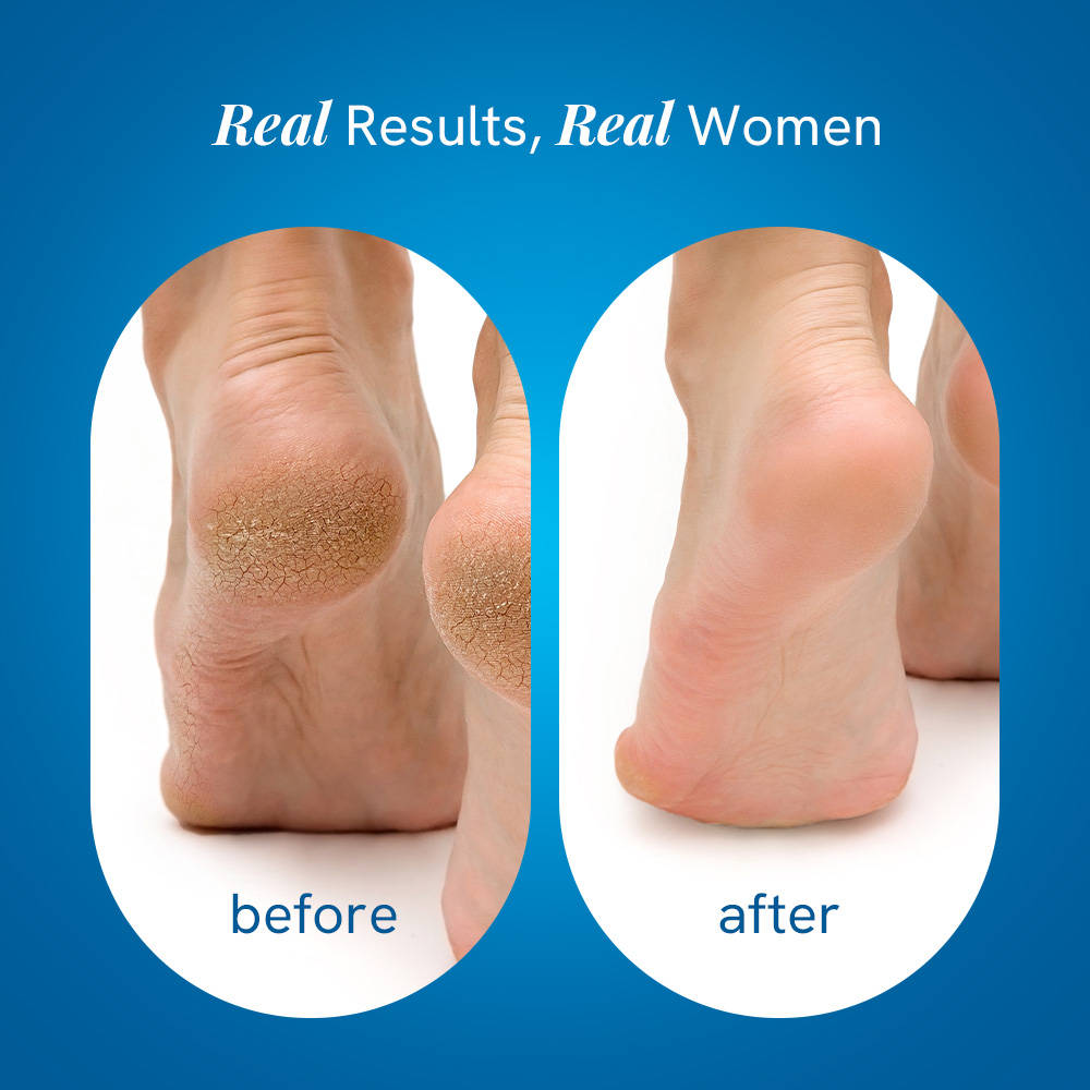 20% Urea Foot & Heel Roll On For Dry Feet & Cracked Heels With Urea & Lactic Acid | BWS9 - view 7