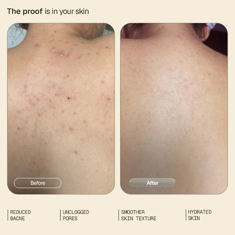 1% Salicylic Acid Daily Body Wash Exfoliates Clears Back Acne & Improves Strawberry Skin | B20 - view 3