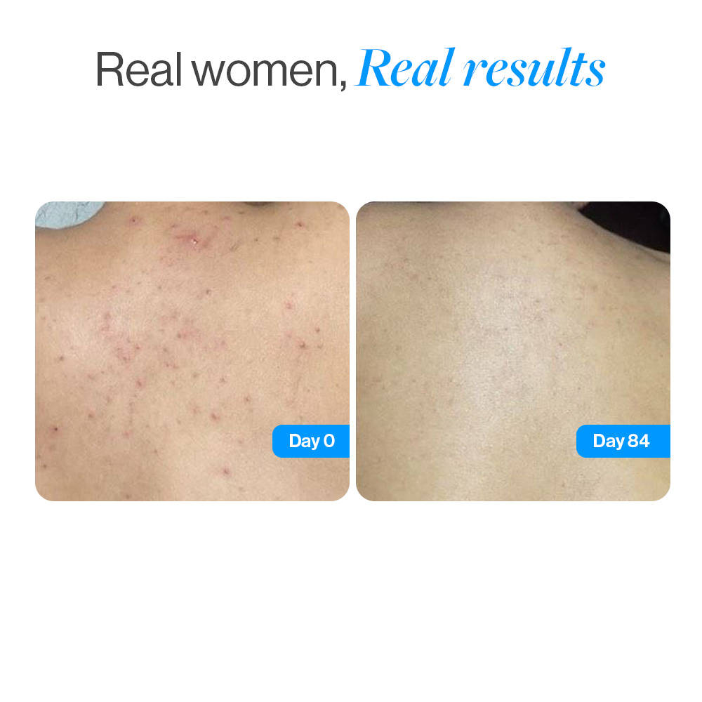1% Salicylic Ceramide Body Wash - Dual Pump 2in1 Body Wash - For Body Acne and Dry Skin | BWS9 - view 8