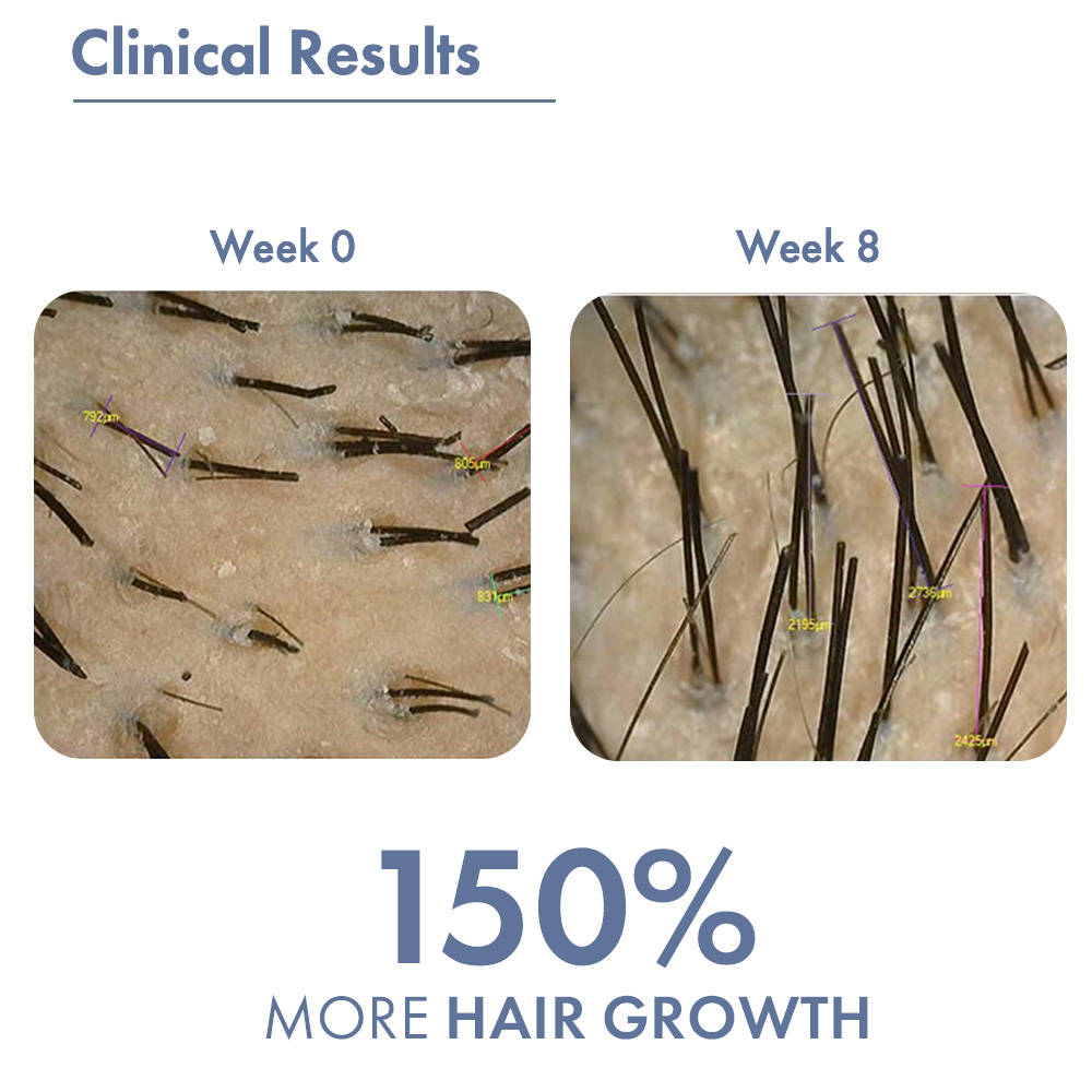 Hair Growth Serum with Redensyl, Rosemary, Procapil, AnaGain & Hyaluronic Acid | H85 - view 4