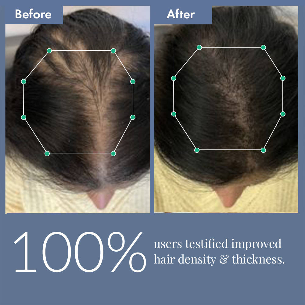 Hair Growth Serum with Redensyl, Rosemary, Procapil, AnaGain & Hyaluronic Acid | H85 - view 5