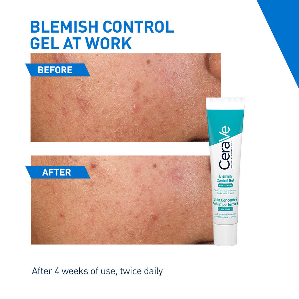 Blemish Control Gel with 2% Salicylic Acid, AHA & Niacinamide for Acne Spot Treatment | FC3 - view 4