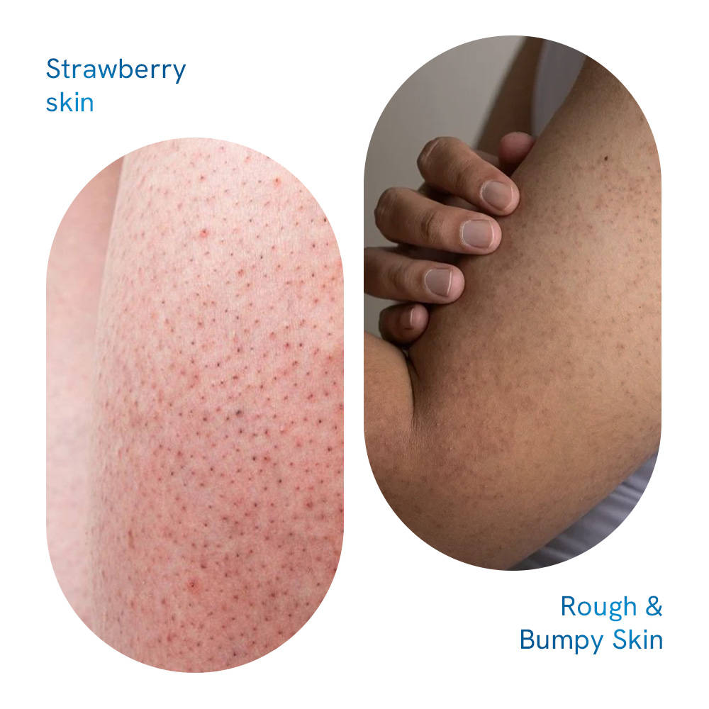 16% Actives Strawberry Skin Pack Fights Keratosis Pilaris, Tiny Bumps & Strawberry Skin | BWS9 - view 4