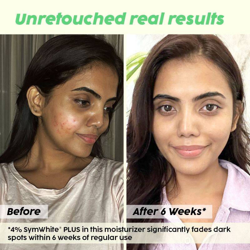 2% Alpha Arbutin Pineapple Moisturizer With SymWhite PLUS For Hyperpigmentation & Dark Spots | PL1 - view 4