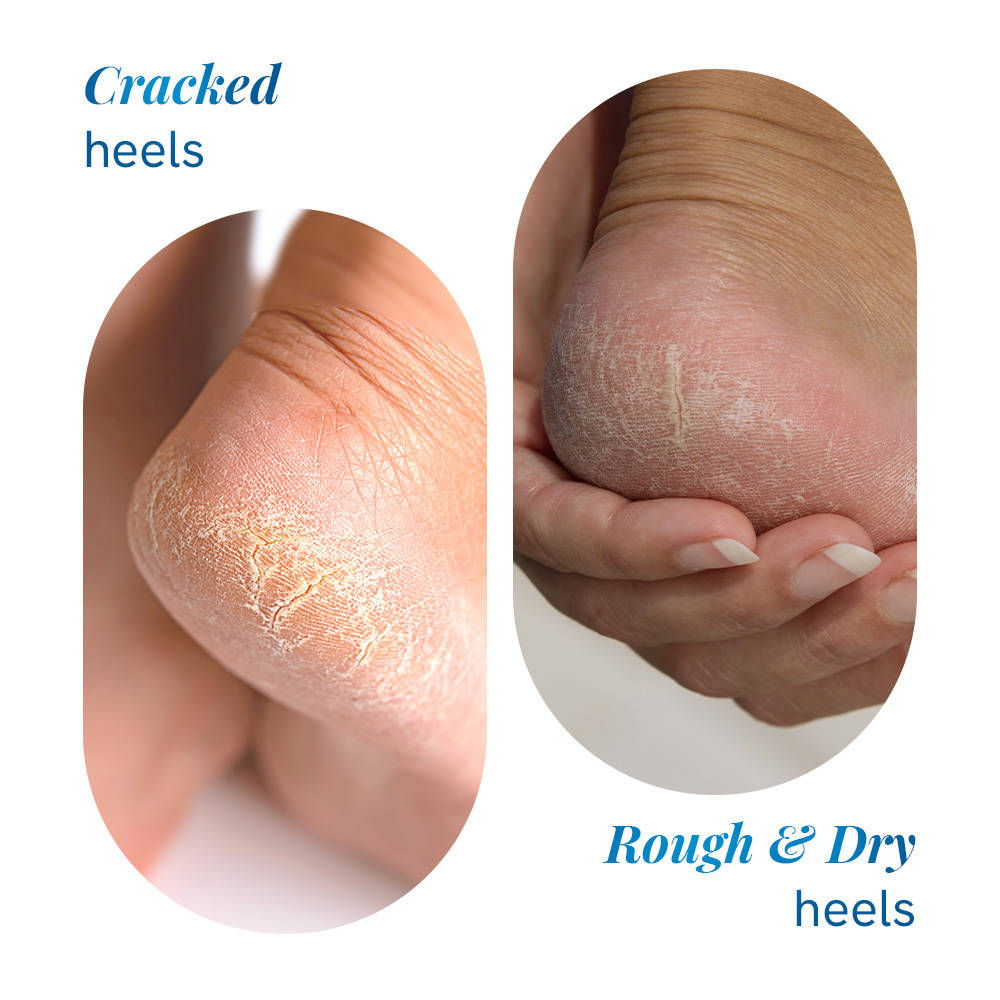 20% Urea Foot & Heel Roll On For Dry Feet & Cracked Heels With Urea & Lactic Acid | BWS9 - view 15