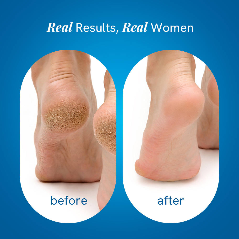 20% Urea Foot & Heel Roll On For Dry Feet & Cracked Heels With Urea & Lactic Acid | BWS9 - view 19
