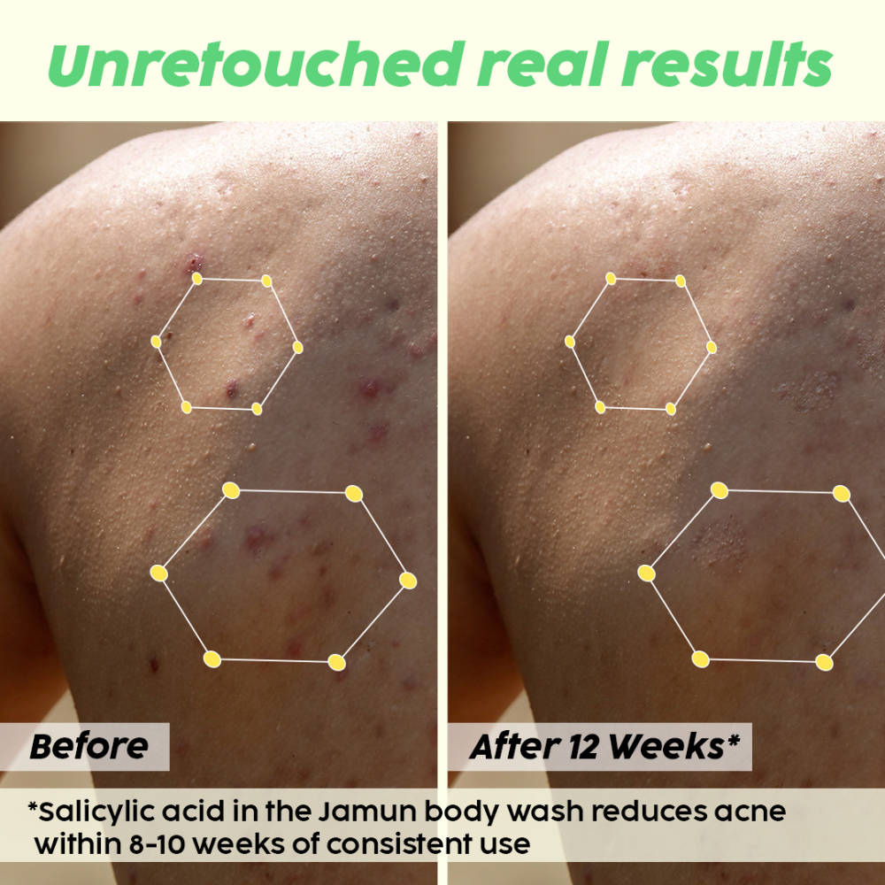 2% Salicylic Acid Body Wash For Body Acne, Deeply Exfoliating Dead Skin Cells, Moisturizes Skin | PL1 - view 8