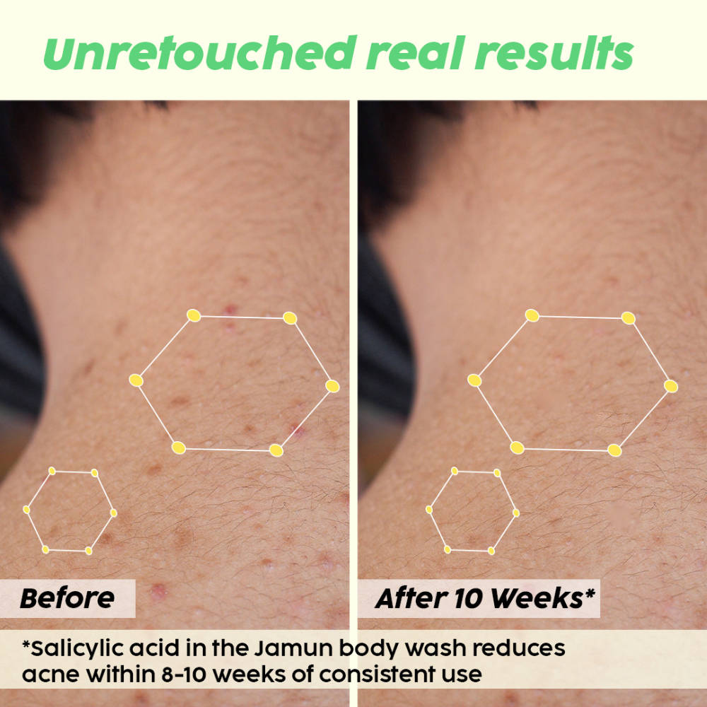Salicylic Acid Cleanser & Body Wash Combo | PL1 - view 11
