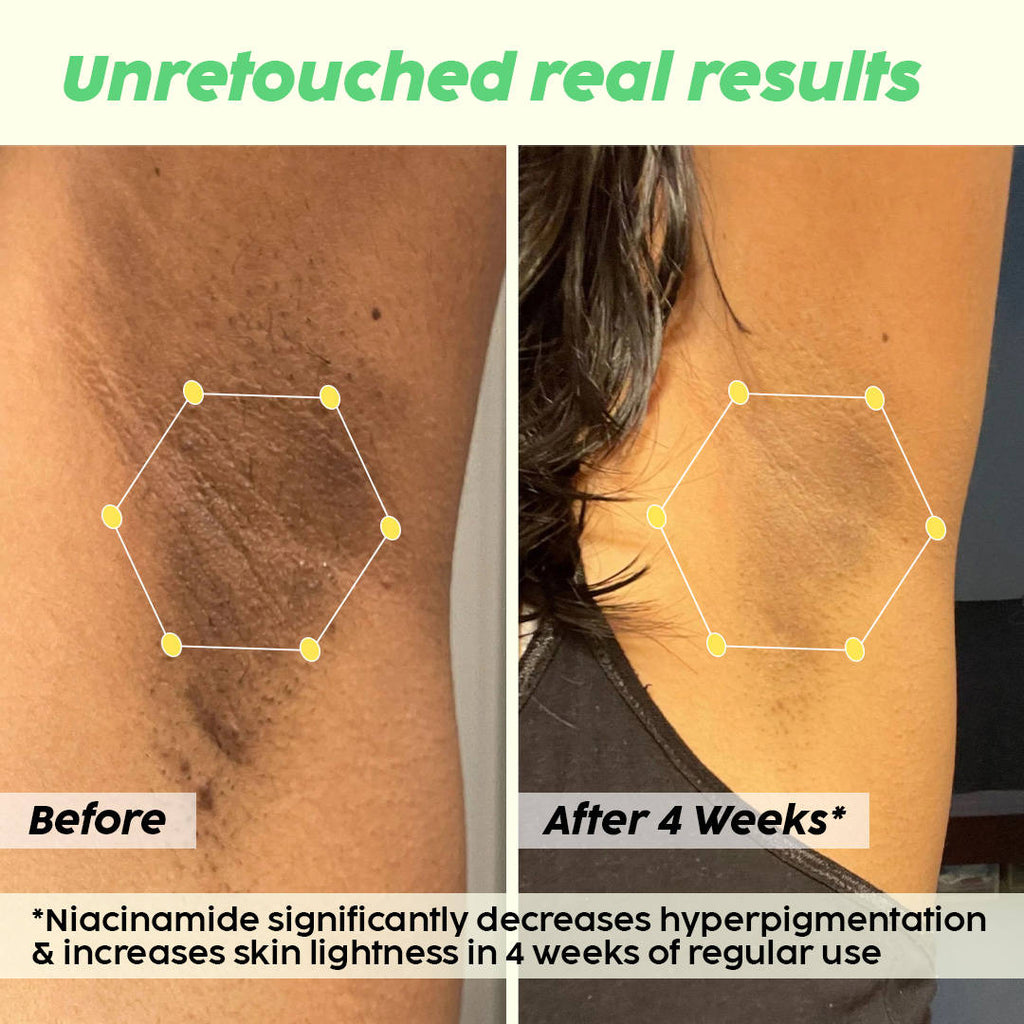 Pineapple Underarm Depigmentation Spray, For Lightening, Hyperpigmentation, Odour protection | PL1 - view 4